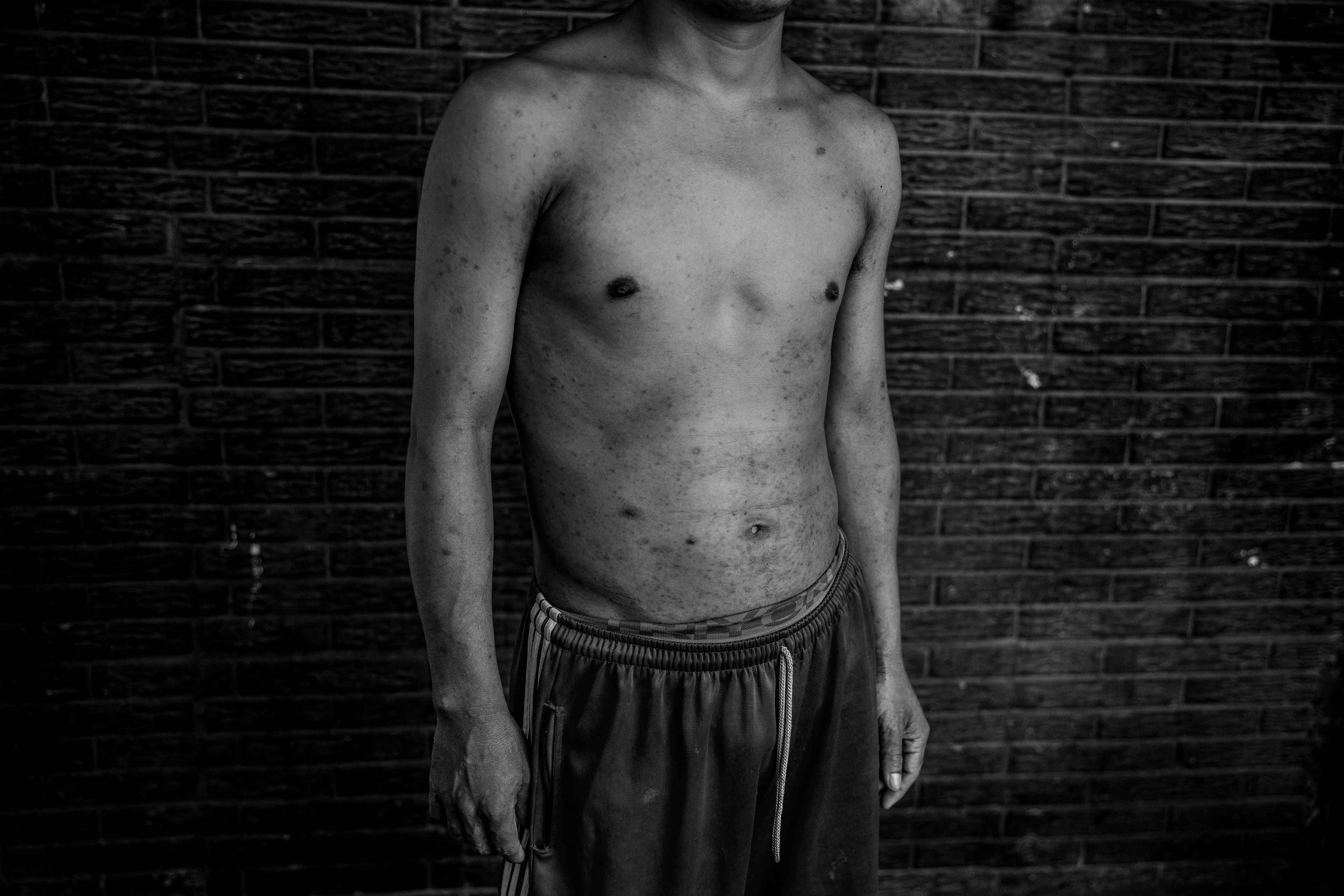 Samuel was arrested despite his condition. For 13 months, he was treated cruelly: He was beaten by guards, subjected to humiliating punishments, his cellmates stole his food and medicine, and he was forced to live in abhorrent conditions. He claims to have seen several cellmates commit suicide by hanging. He is a man with mental health problems who was captured during the state of exception. In prison, he developed a skin condition.